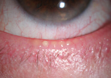 Kuru Gözlerinizin Nedeni: Meibomian Bezi Disfonksiyonu (MGD)