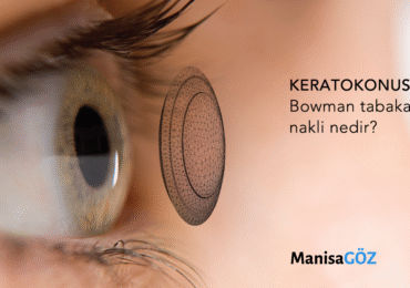 İleri evre Keratokonus tedavisinde yeni bir seçenek